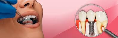 Common Myths About Dental Implants Newcastle Debunked